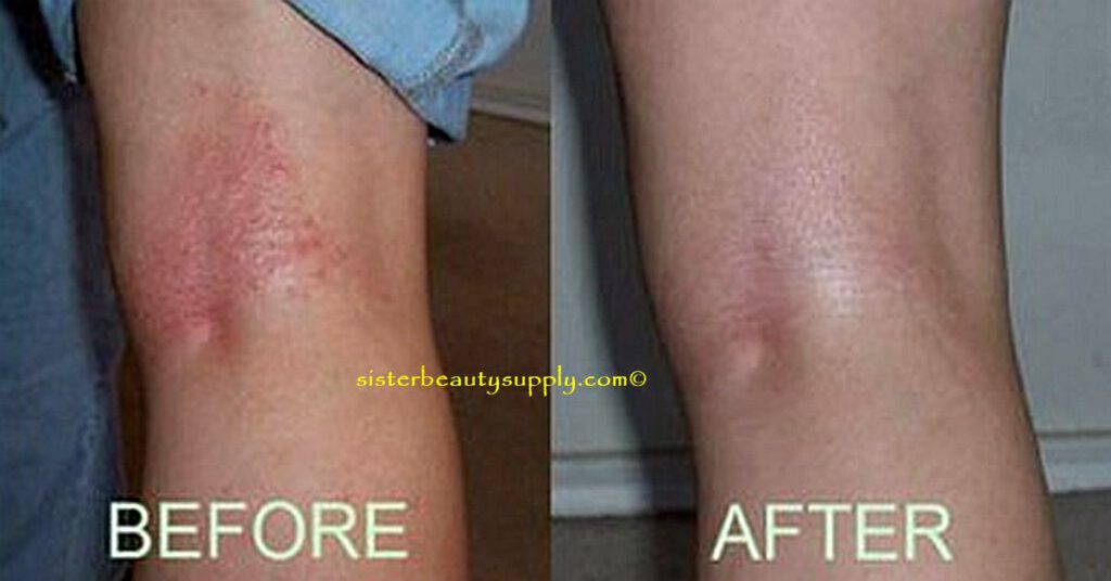 Treat Eczema Skin Rash