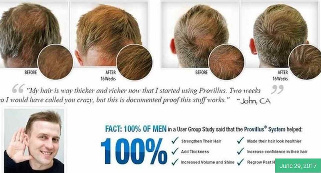 provillus hair loss treatment