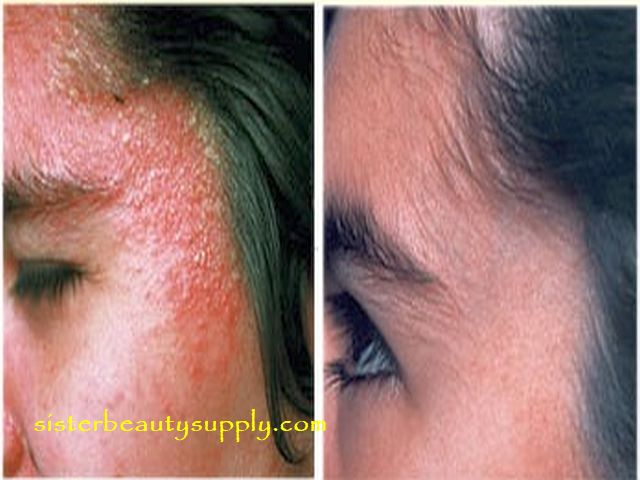 Treat eczema skin rash